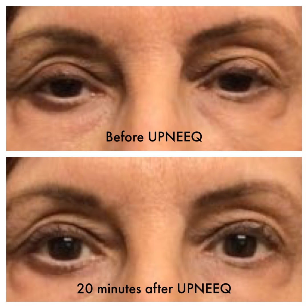 UPNEEQbeforeafterrealpatientexampledermatologycenterofatlantatwentyminues-min