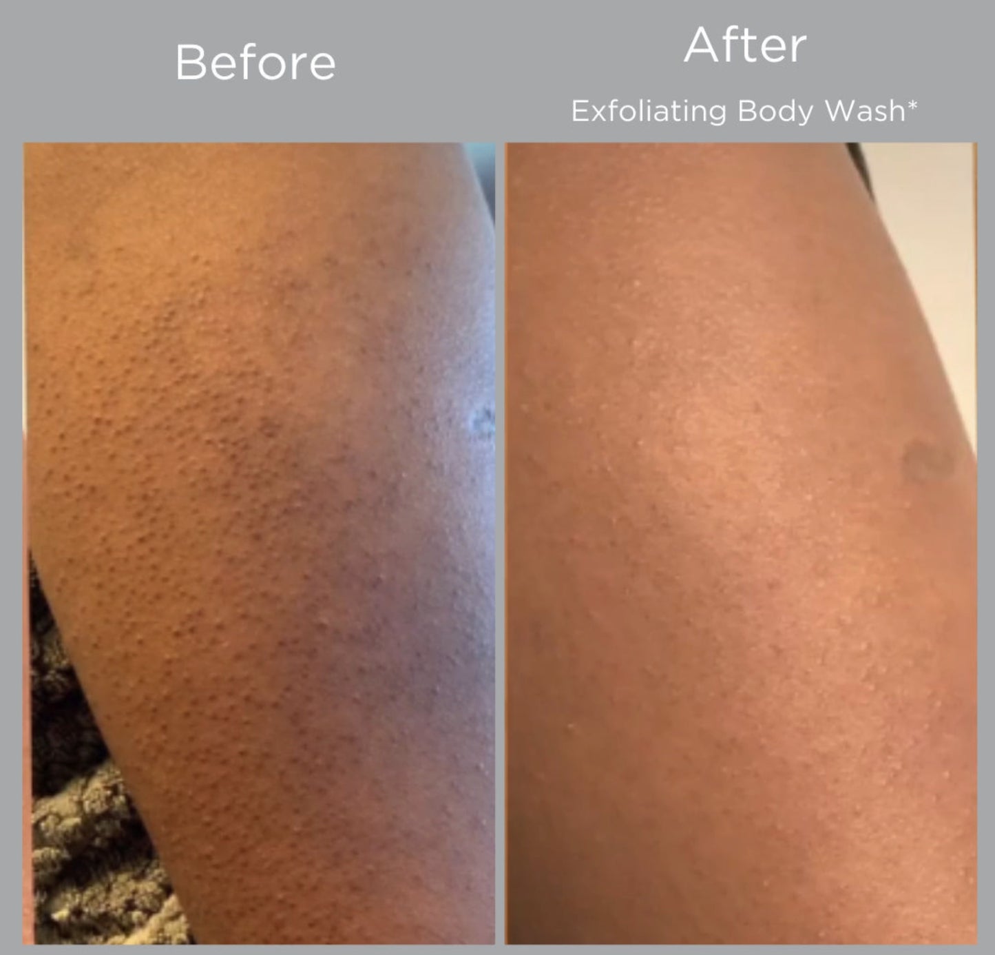 Glytone-Exfoliating-Body-Wash-DCA-advanced-skincare-center-before-after