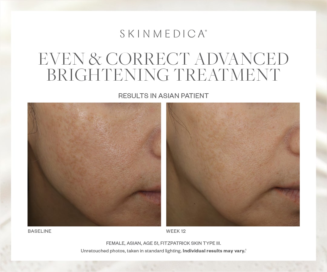 SkinMedica Even & Correct Advanced Brightening Treatment
