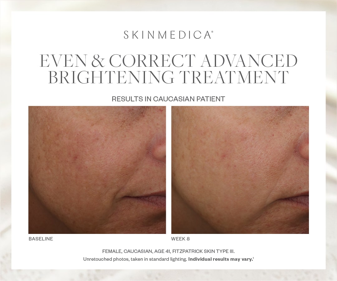 SkinMedica Even & Correct Advanced Brightening Treatment