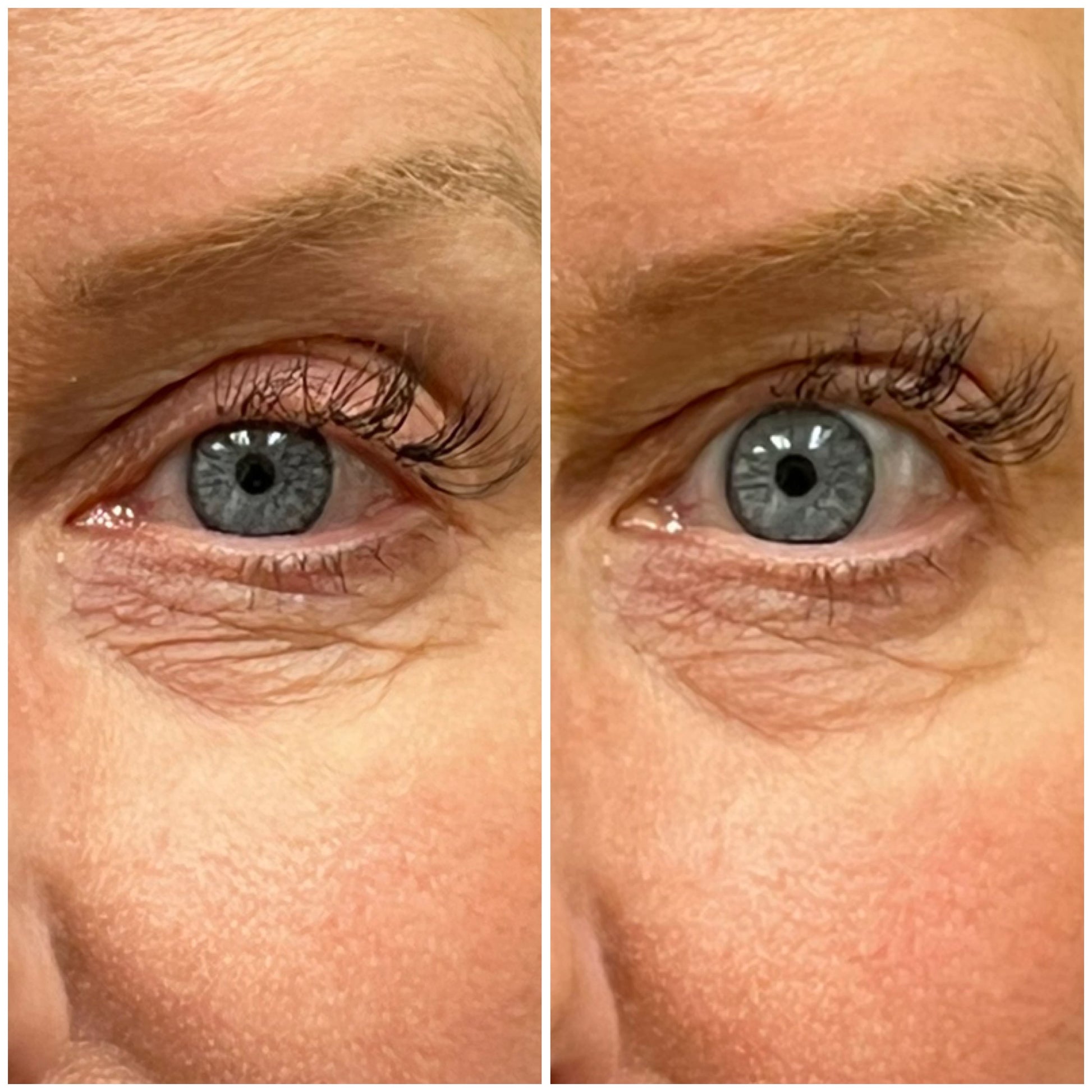Upneez_before-after-30minutes_Brenda-