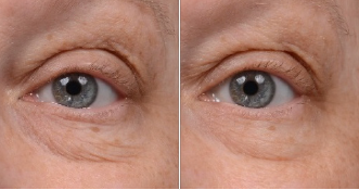 skinmedica-instant-bright-eye-cream-before-after-dca-advanced-skincare-center