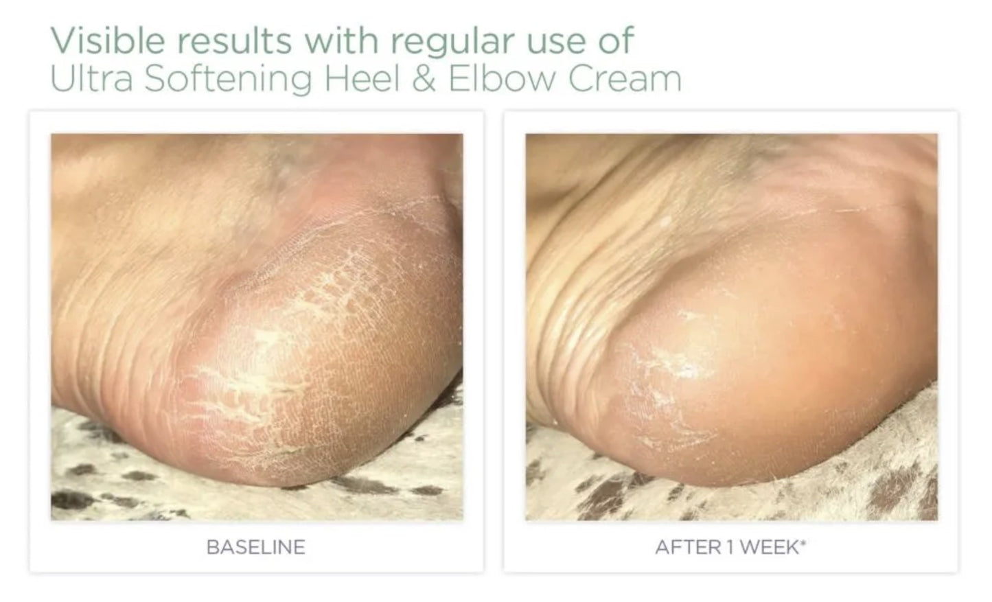 Glytone-ultra-softening-heel-elbow-cream-before-after-specialty-dca-advanced-skincare-center-before-after