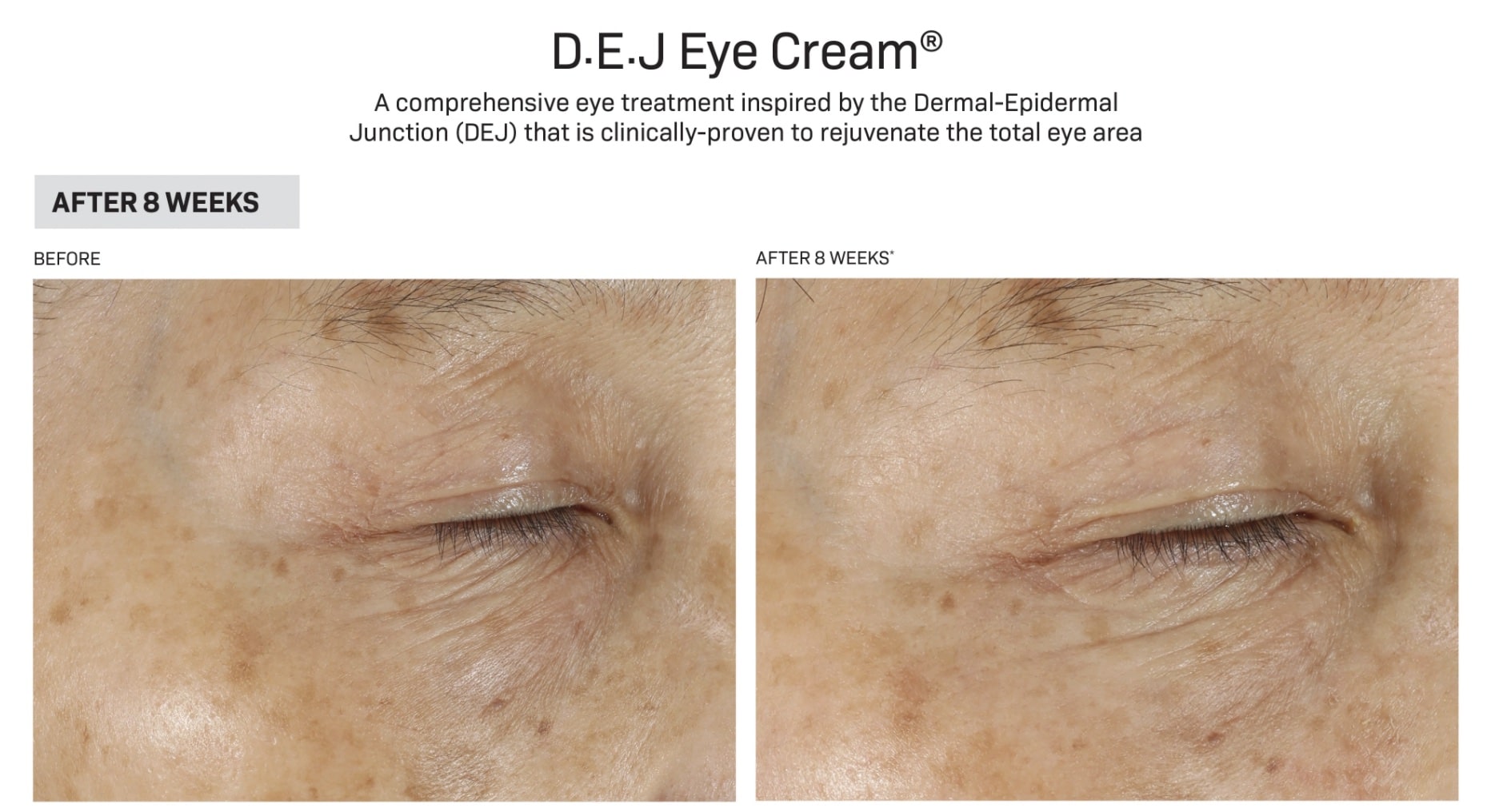    Revision-dej-eye-before-after-dca-advanced-skincare-center