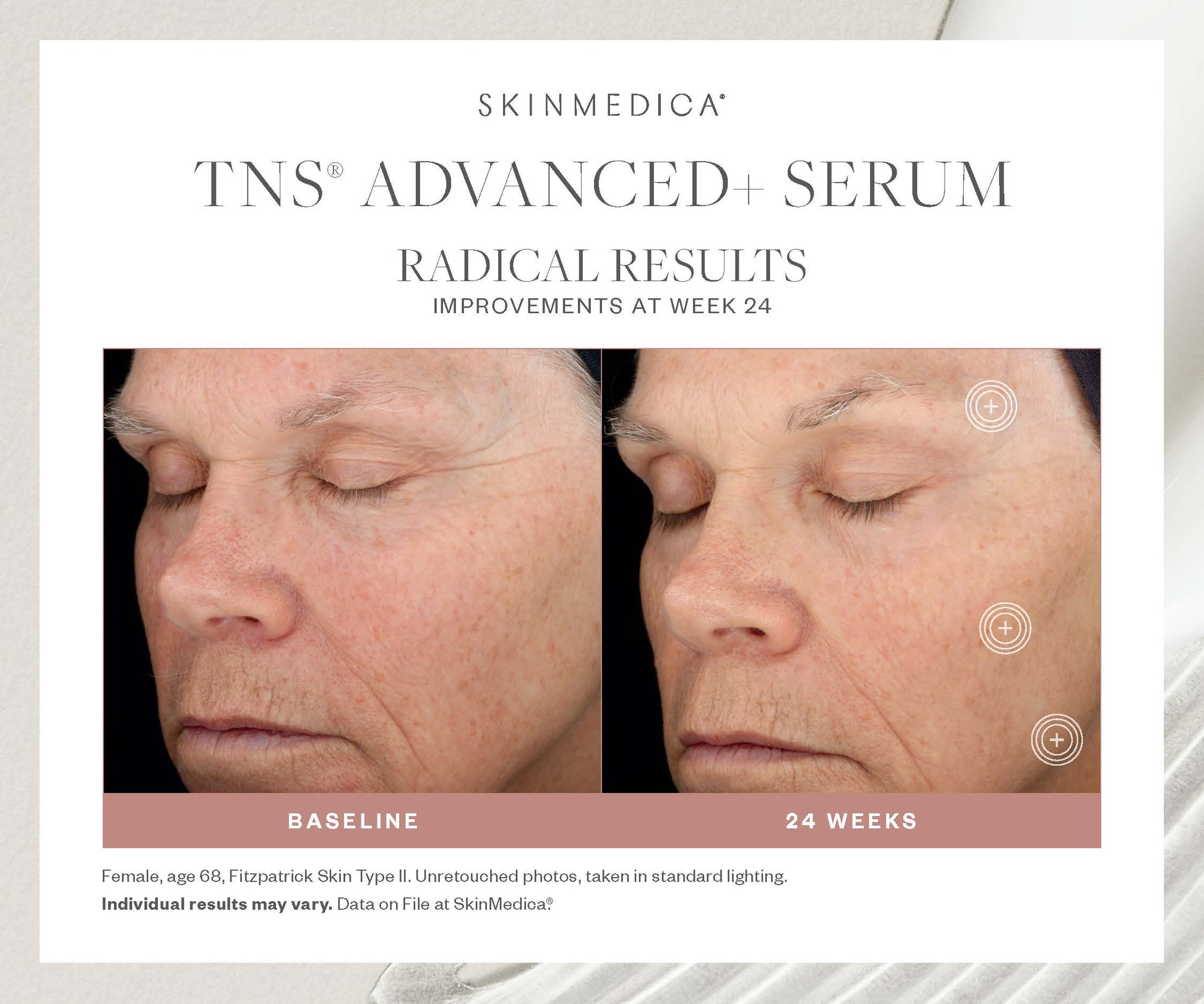 SkinMedica TNS Advanced+ Serum Before AFter 24 weeks-dca-advanced-skincare-center
