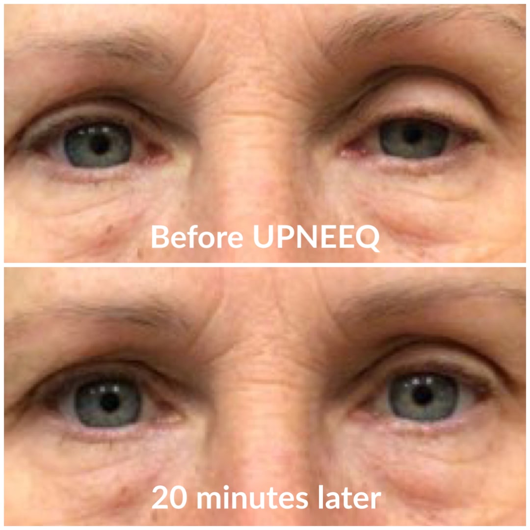 Upneeq-Before-After-20minutes-patient-exampledermatologycenterofatlanta-min