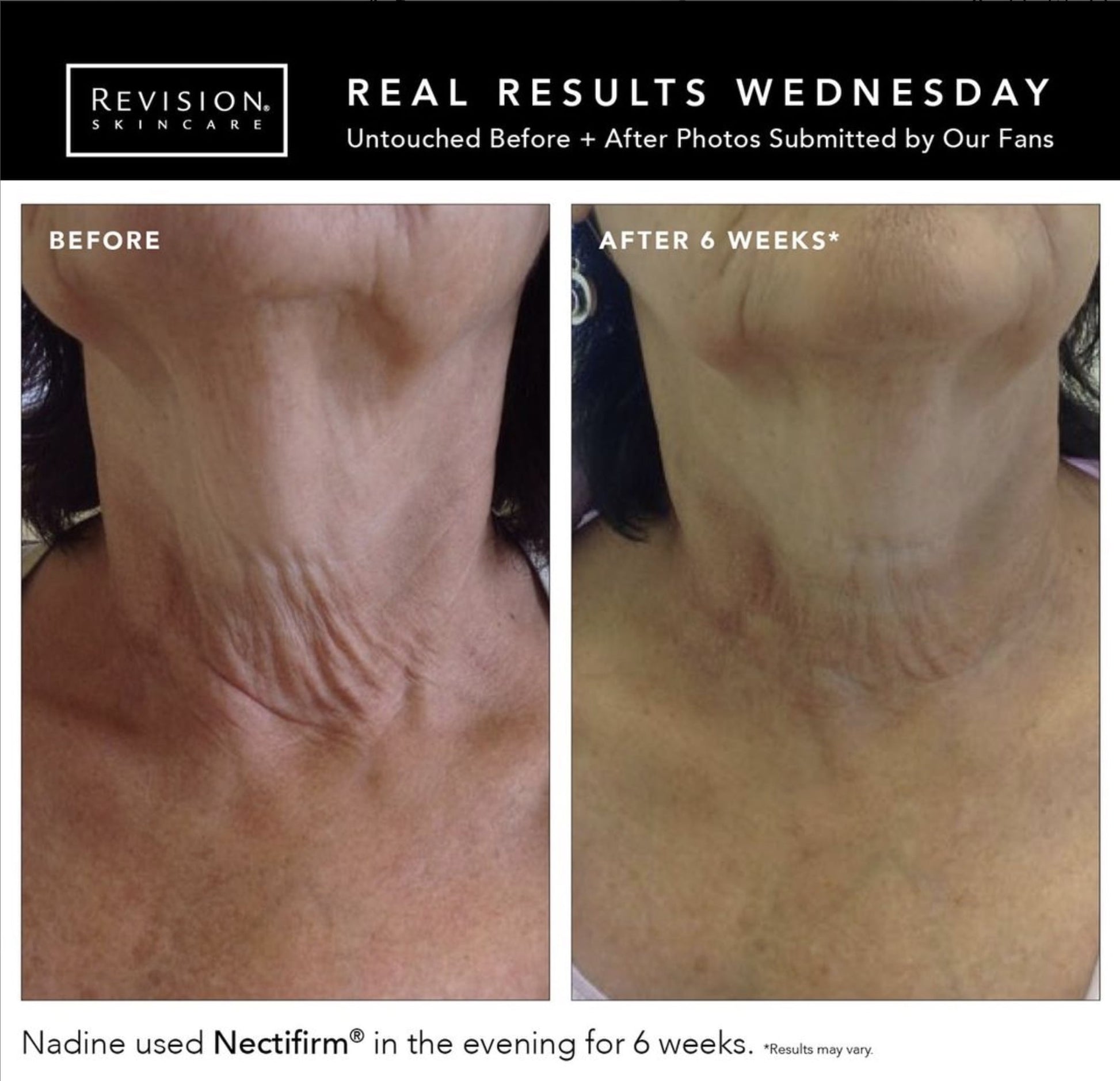 revision-nectifirm-advanced-before-after-dca-advanced-skincare-center