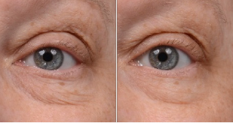    skinmedica-instant-bright-eye-cream-before-after-dca-advanced-skincare-center